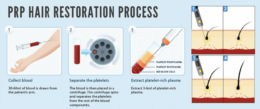 PRP Treatment for Hair Loss