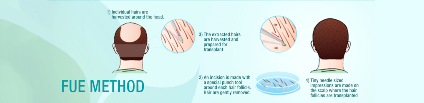 FUe Hair Transplant Ahmedabad Gujarat