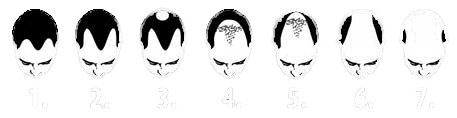 grades of male pattern baldness